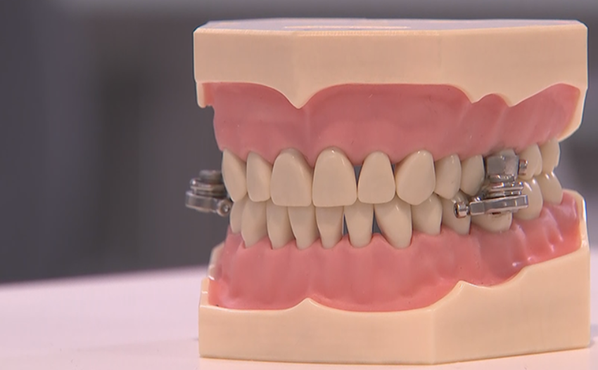  investigadores crean dispositivo dental para bajar de peso